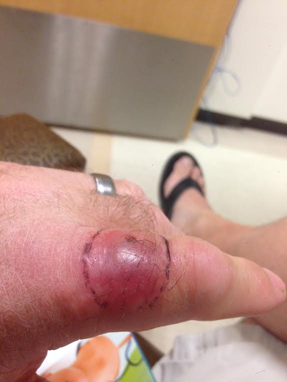 kellysmithblister1.jpg