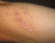 180px-Scar-on-arm.jpg