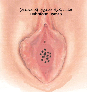 cribriform_hymen.jpg