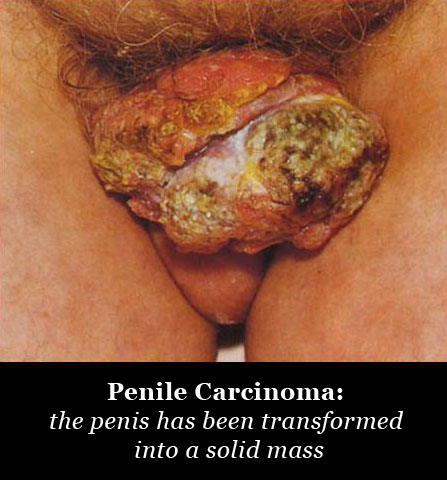 penile_cancer.jpg