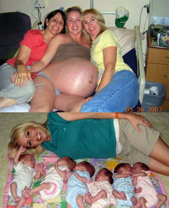 before-and-after-sixtuplets.jpg