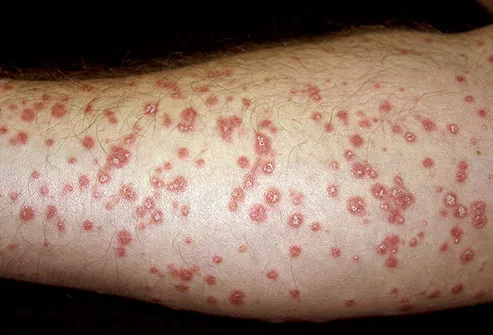 dermnet_rm_photo_of_guttate_psoriasis.jpg